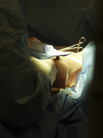 Operationsverfahren Brustvergrößerung
